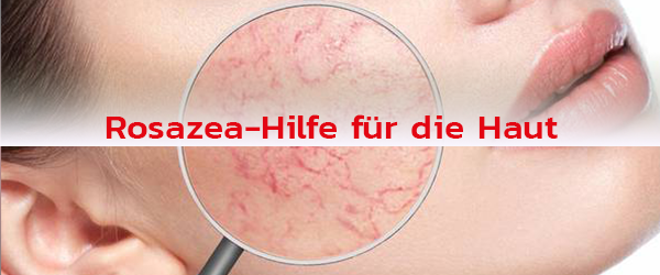 Naturheilkundliche Ansätze bei Rosazea